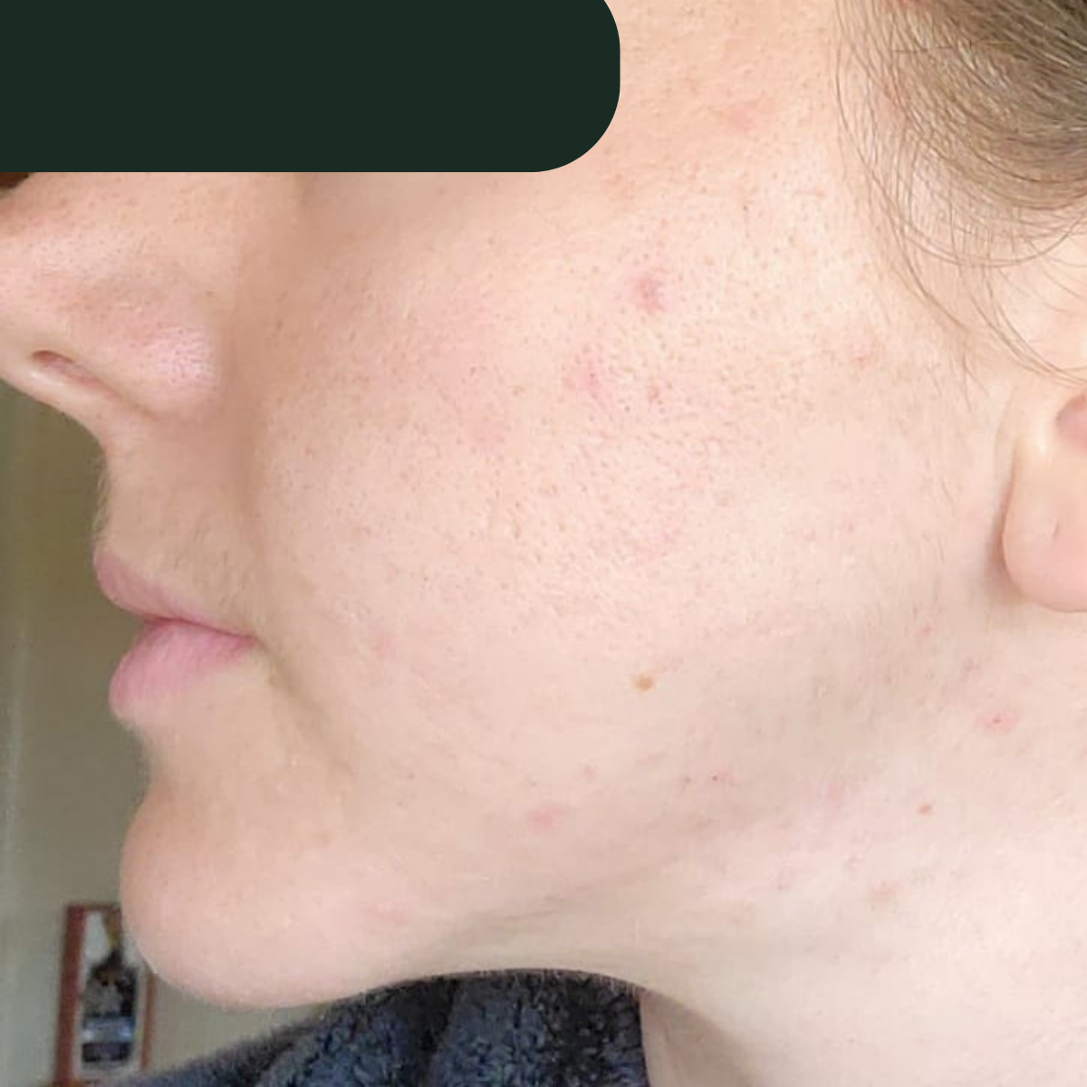 Becky, after the 30-day therapeutic reset inside The Acne Detox