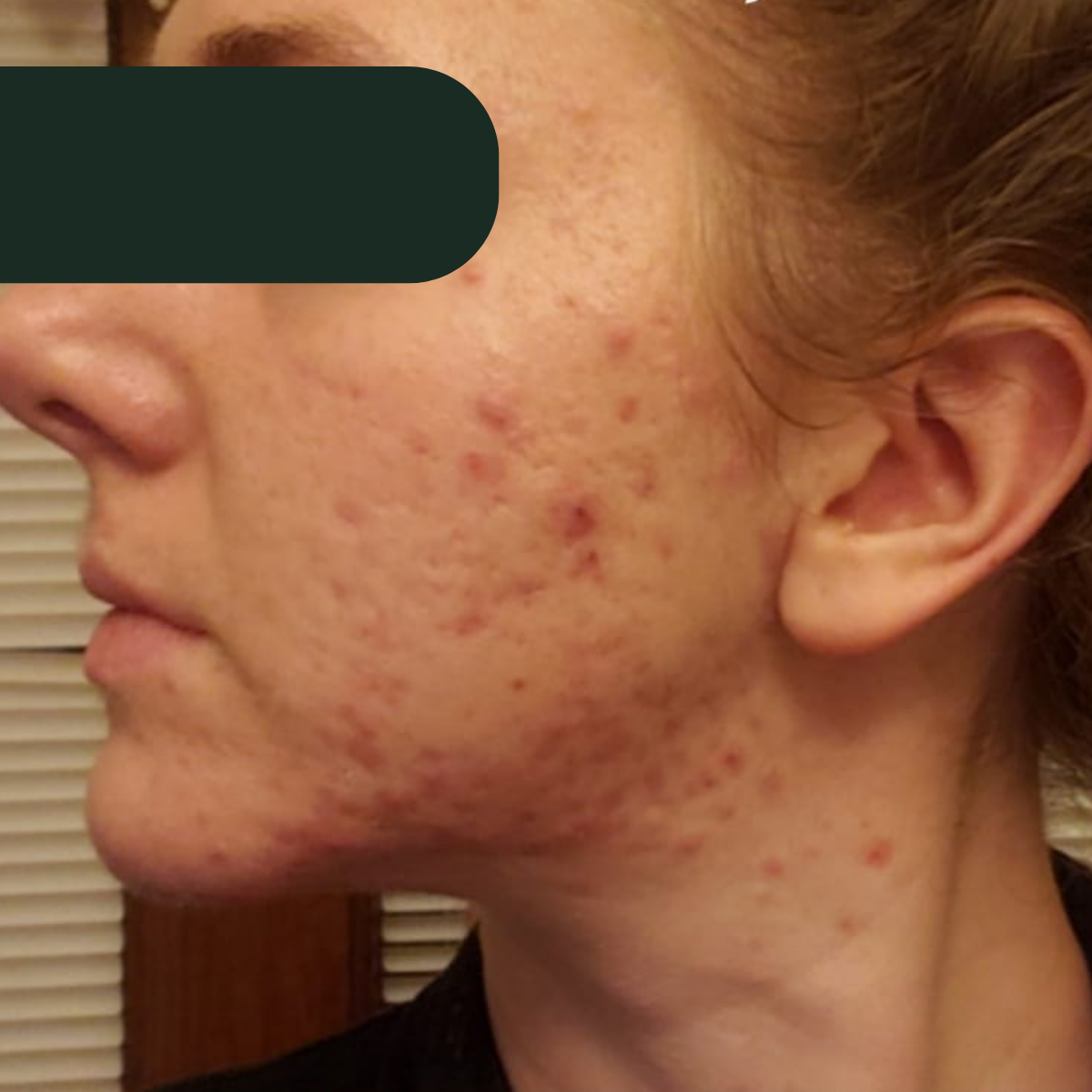 Becky, before the 30-day therapeutic reset inside The Acne Detox
