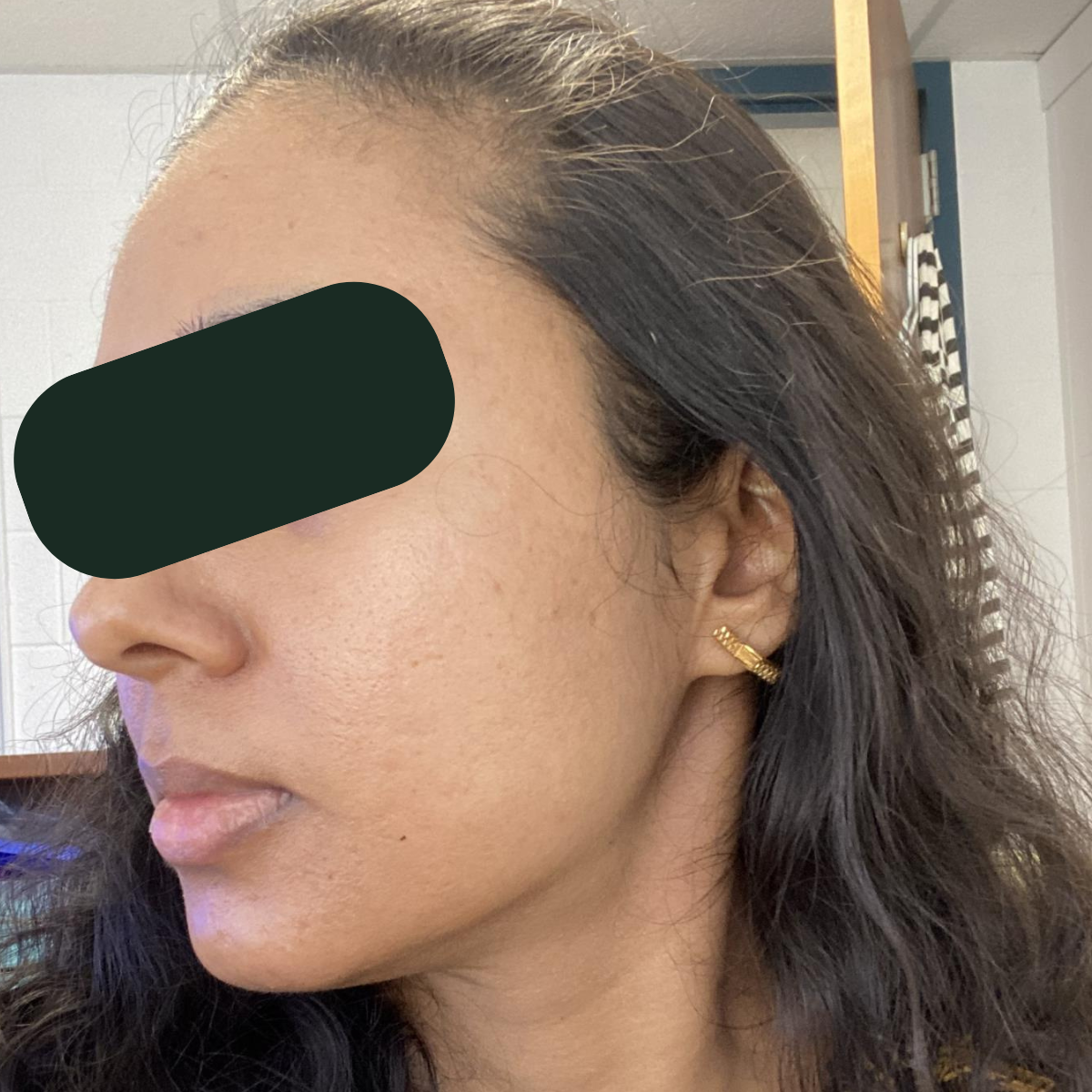Chaitali, after the 30-day therapeutic reset inside The Acne Detox