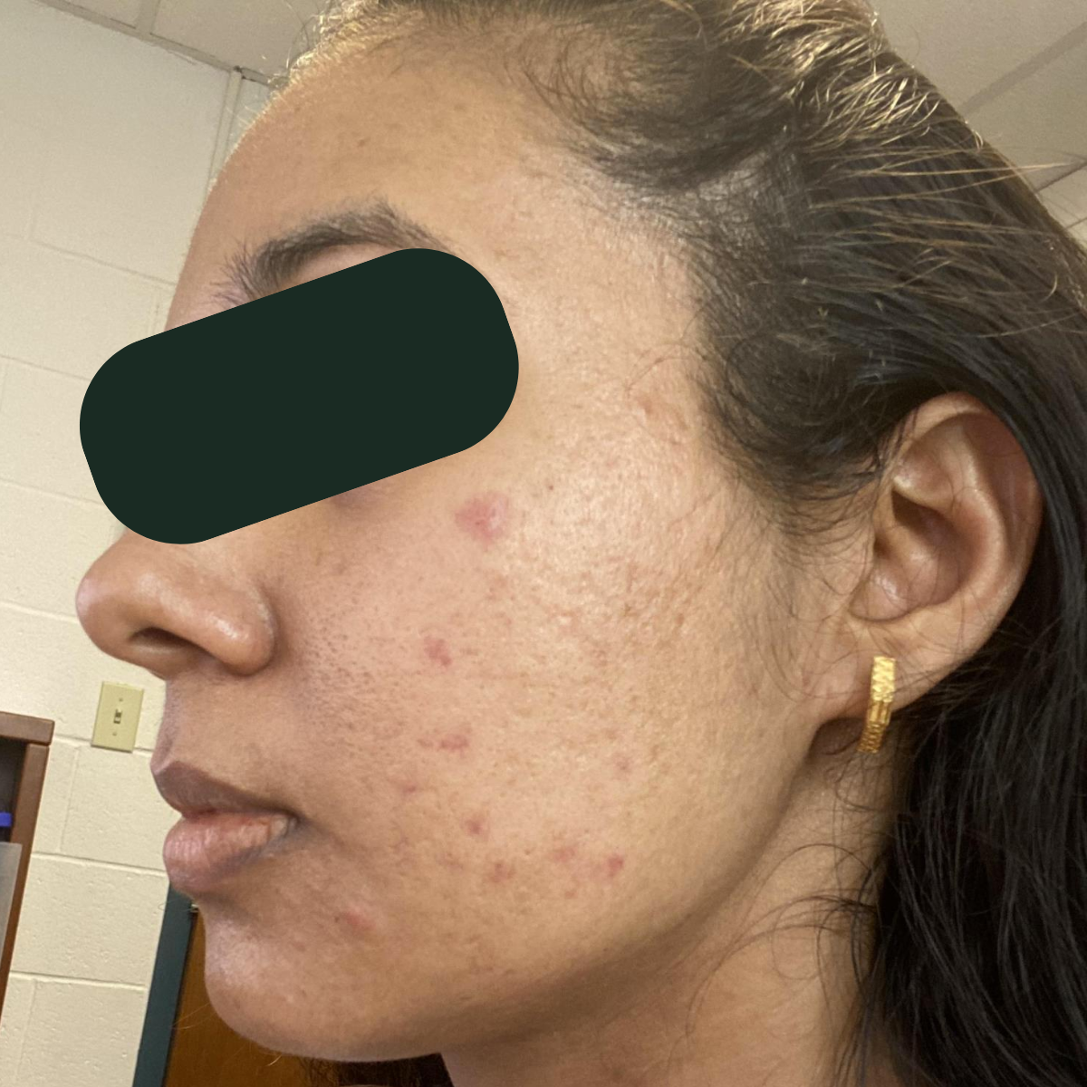 Chaitali, before the 30-day therapeutic reset inside The Acne Detox