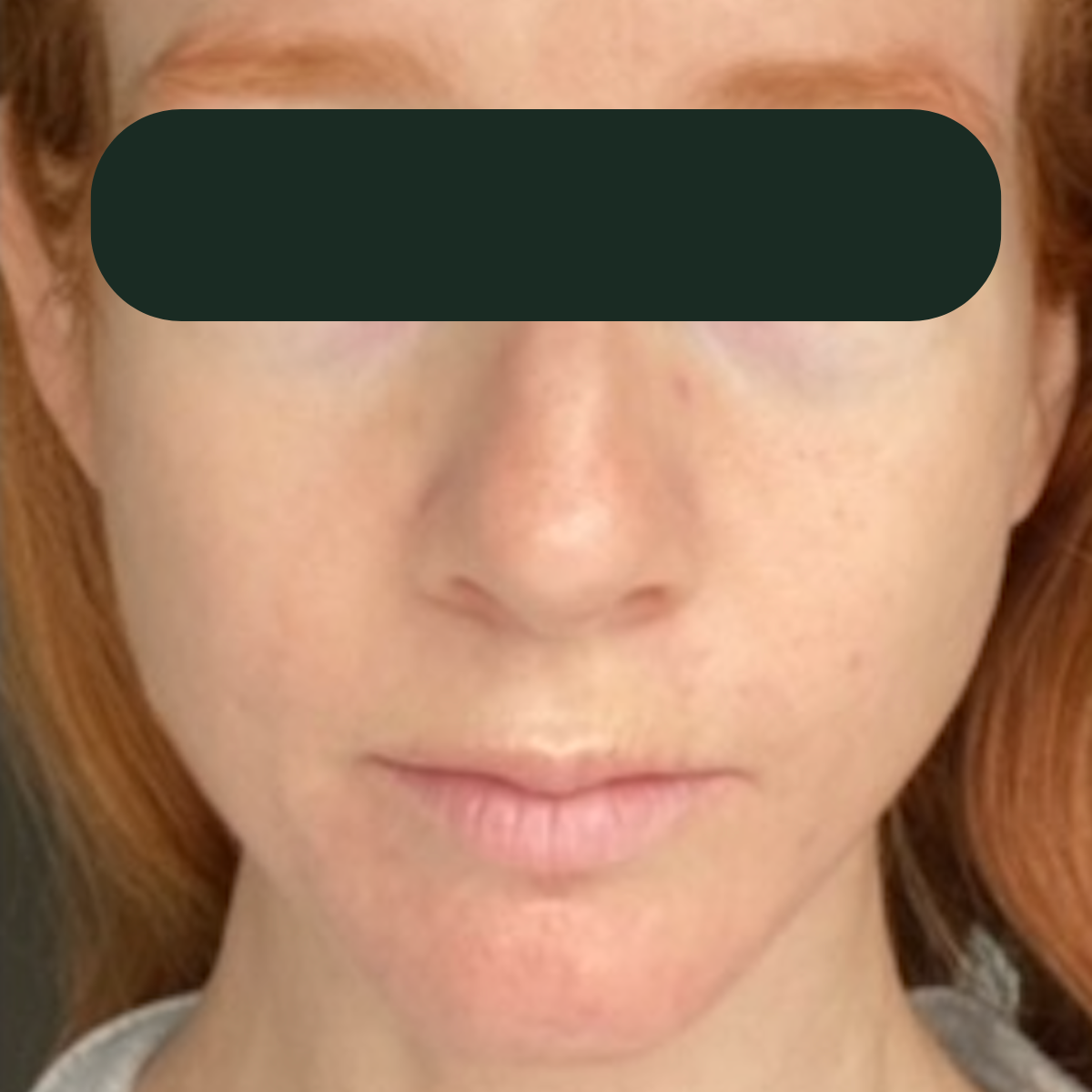 Shelly, after the 30-day therapeutic reset inside The Acne Detox