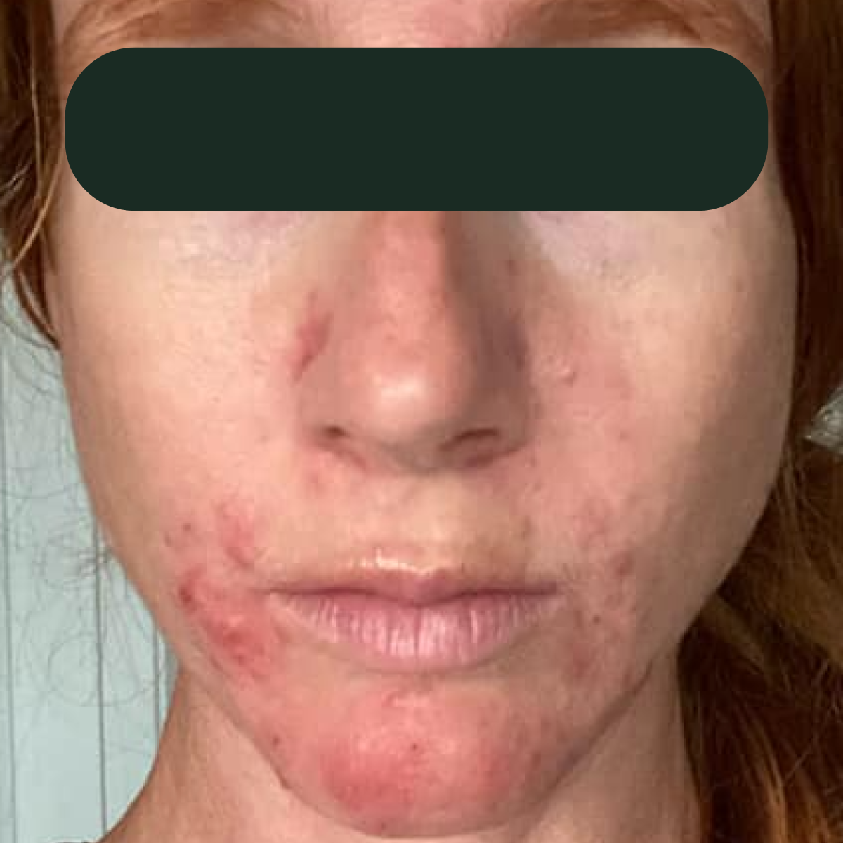Shelly, before the 30-day therapeutic reset inside The Acne Detox