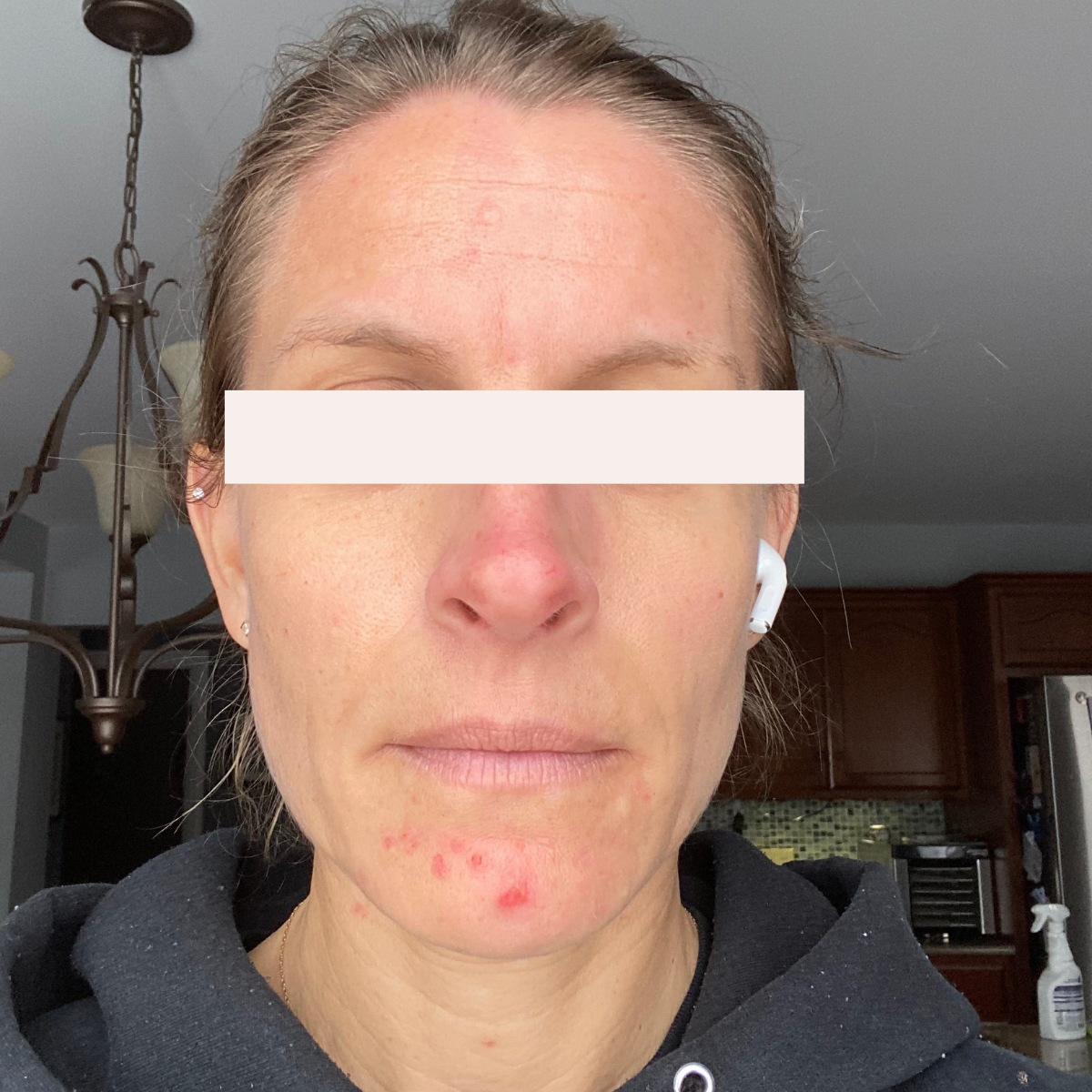 KSW Client before a historically published KSW skin journey