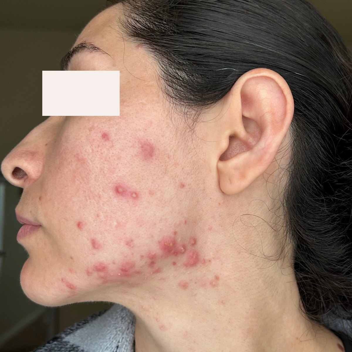 Anacaren before a historically published KSW skin journey