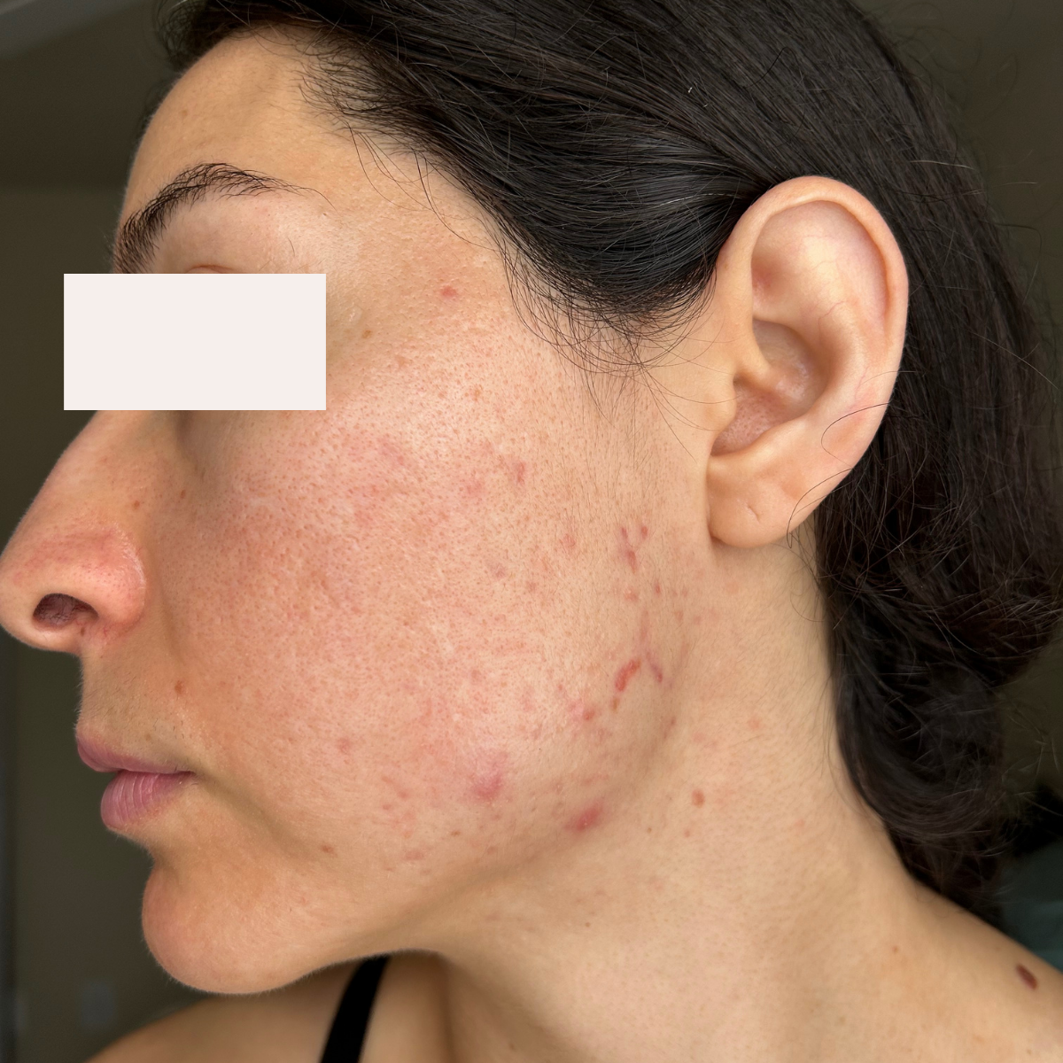 Anacaren after a historically published KSW skin journey