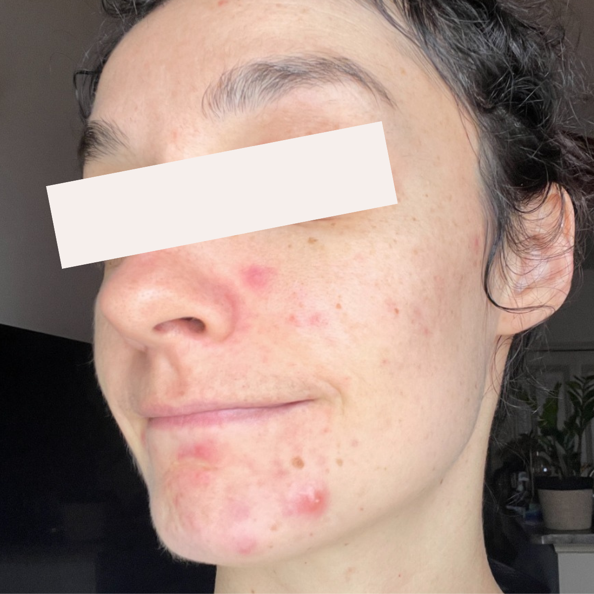 Tay before a historically published KSW skin journey