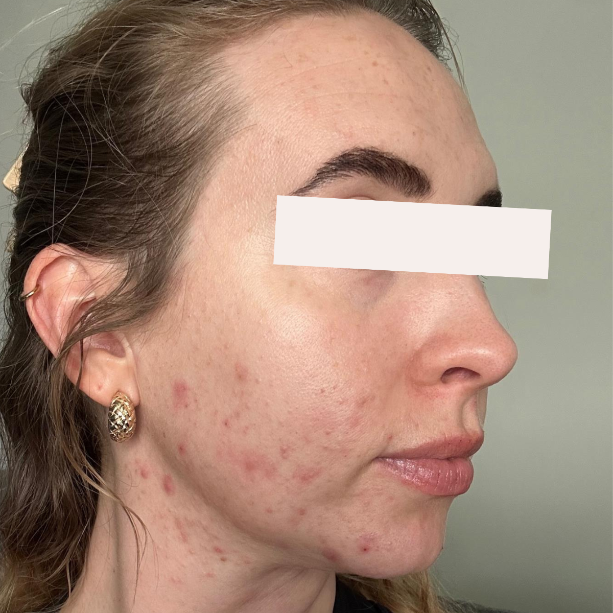 Laina before a historically published KSW skin journey