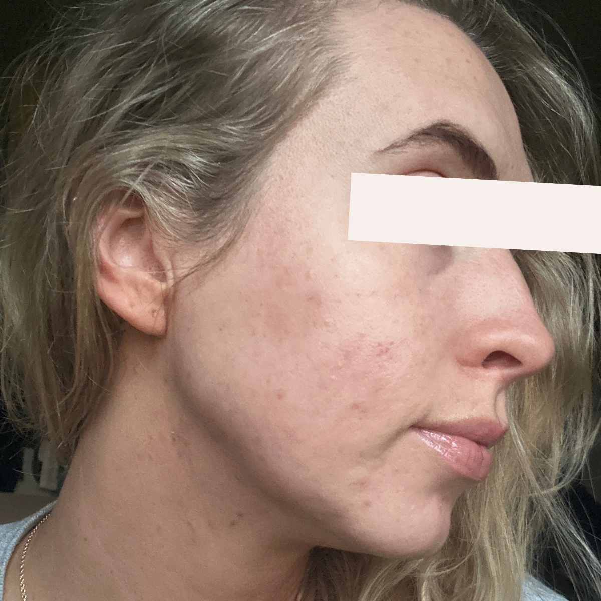 Laina after a historically published KSW skin journey