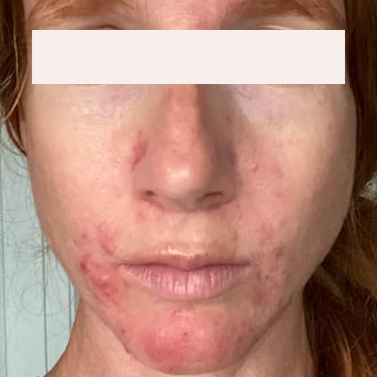 Shelly before a historically published KSW skin journey