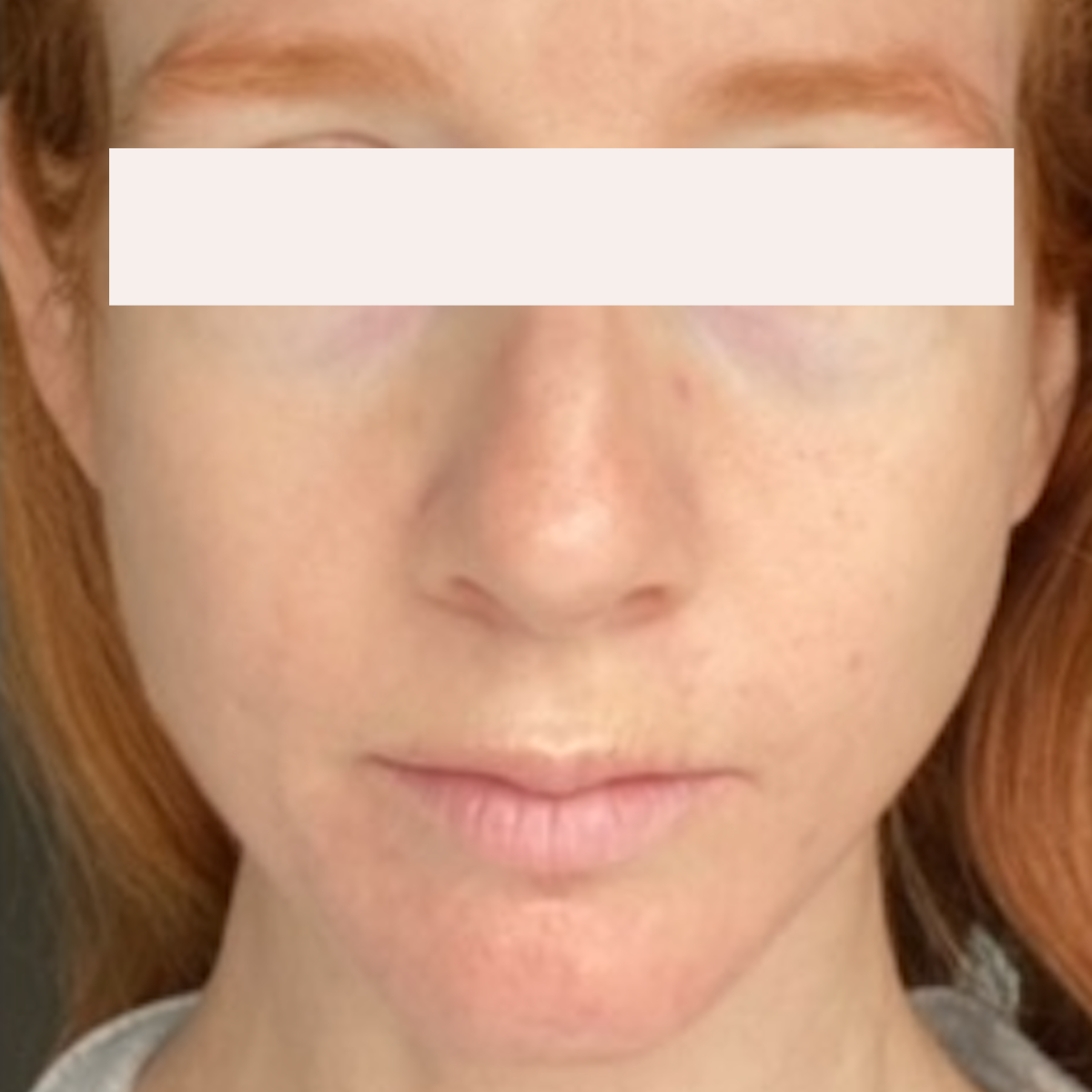 Shelly after a historically published KSW skin journey