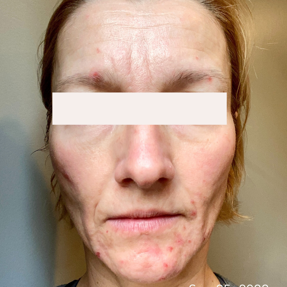Virginia before a historically published KSW skin journey