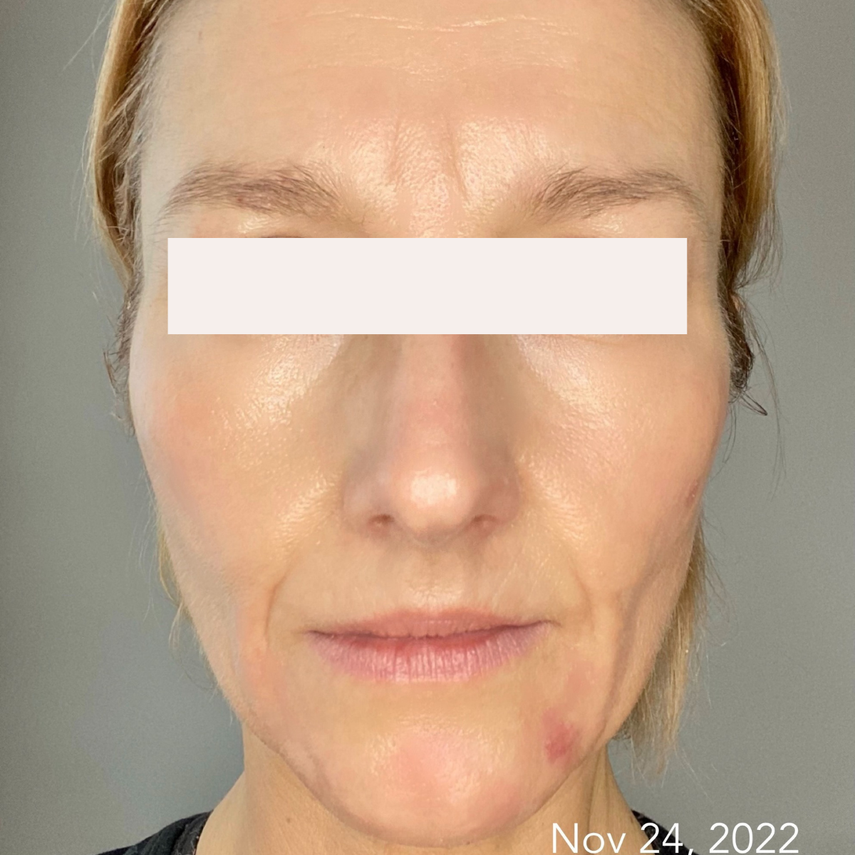 Virginia after a historically published KSW skin journey