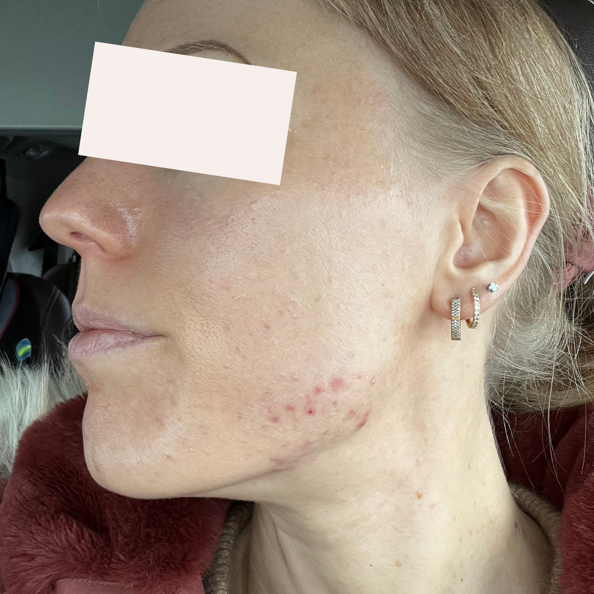 Natasha before a historically published KSW skin journey