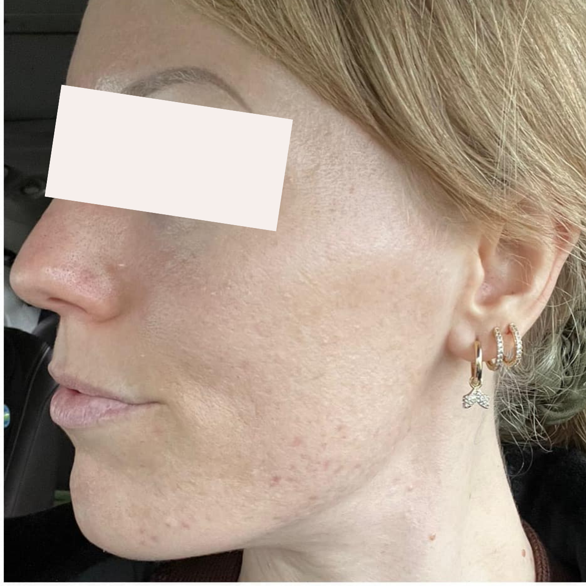 Natasha after a historically published KSW skin journey