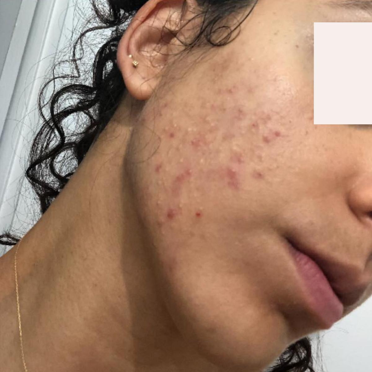 Claudine before a historically published KSW skin journey