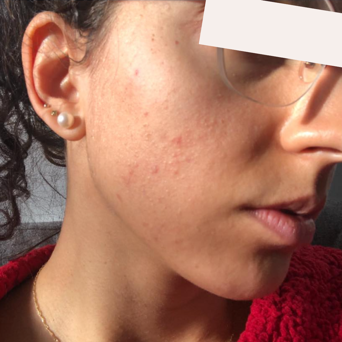 Claudine after a historically published KSW skin journey