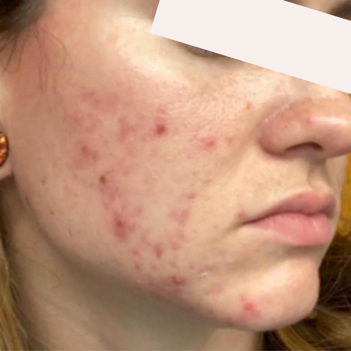 KSW Client before a historically published KSW skin journey