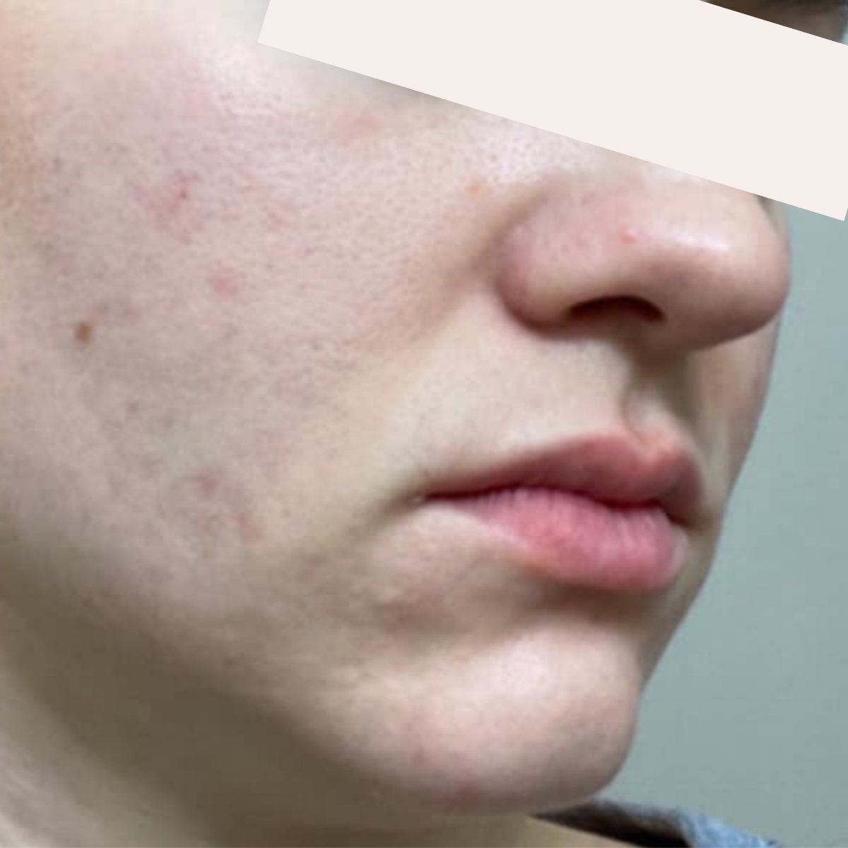 KSW Client after a historically published KSW skin journey