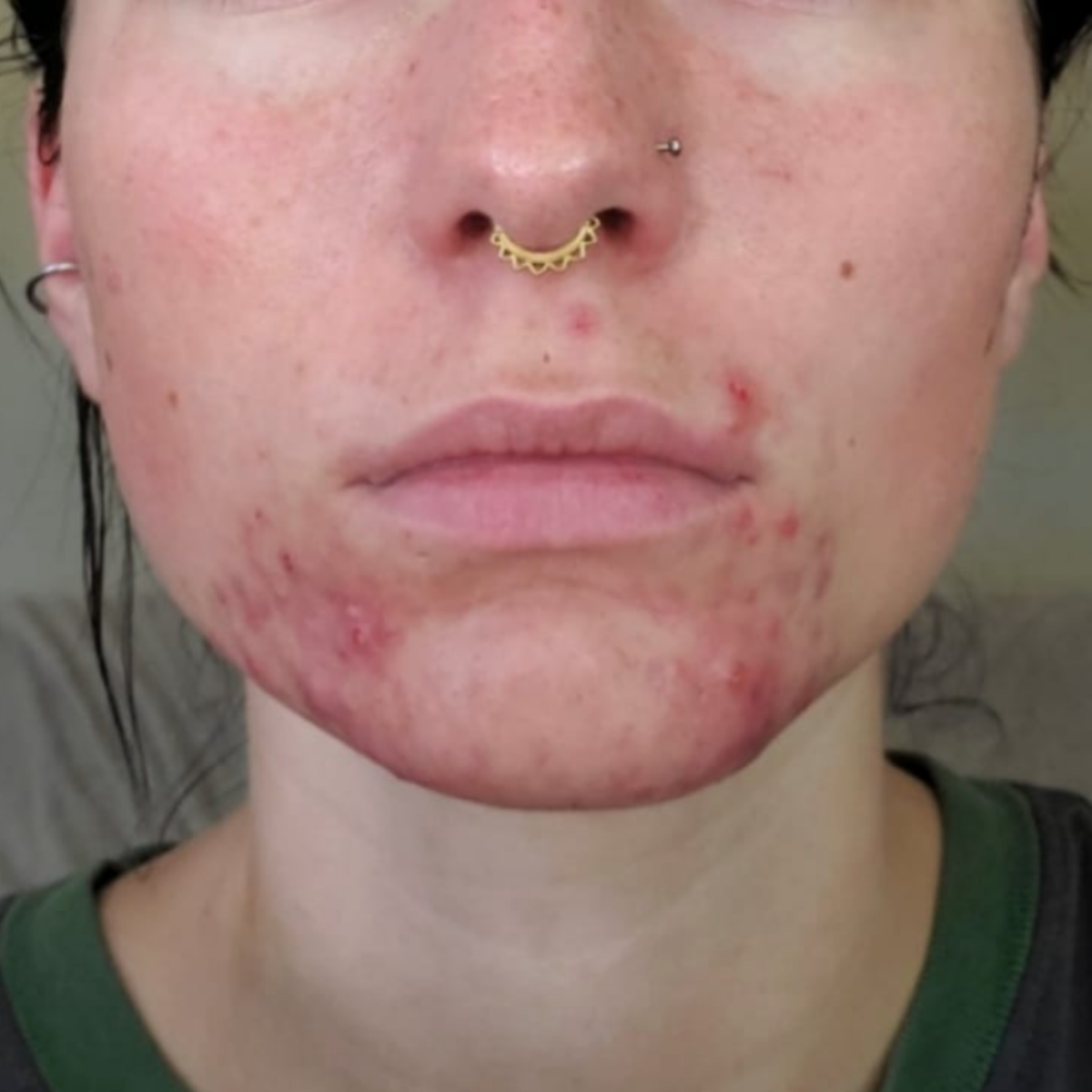 Hayden before a historically published KSW skin journey