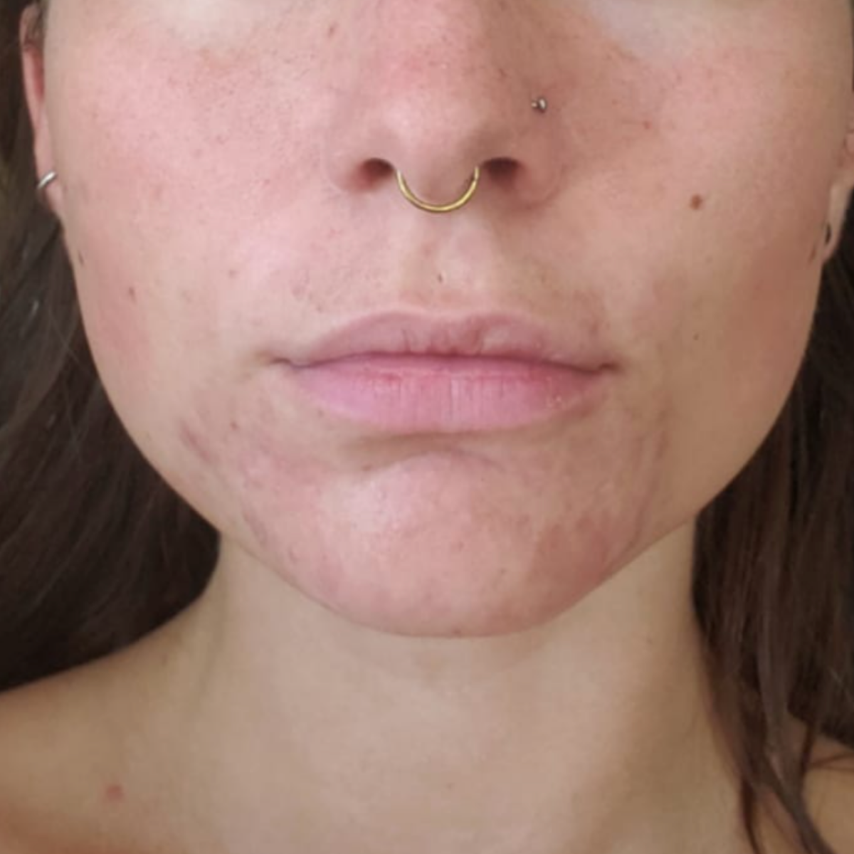 Hayden after a historically published KSW skin journey