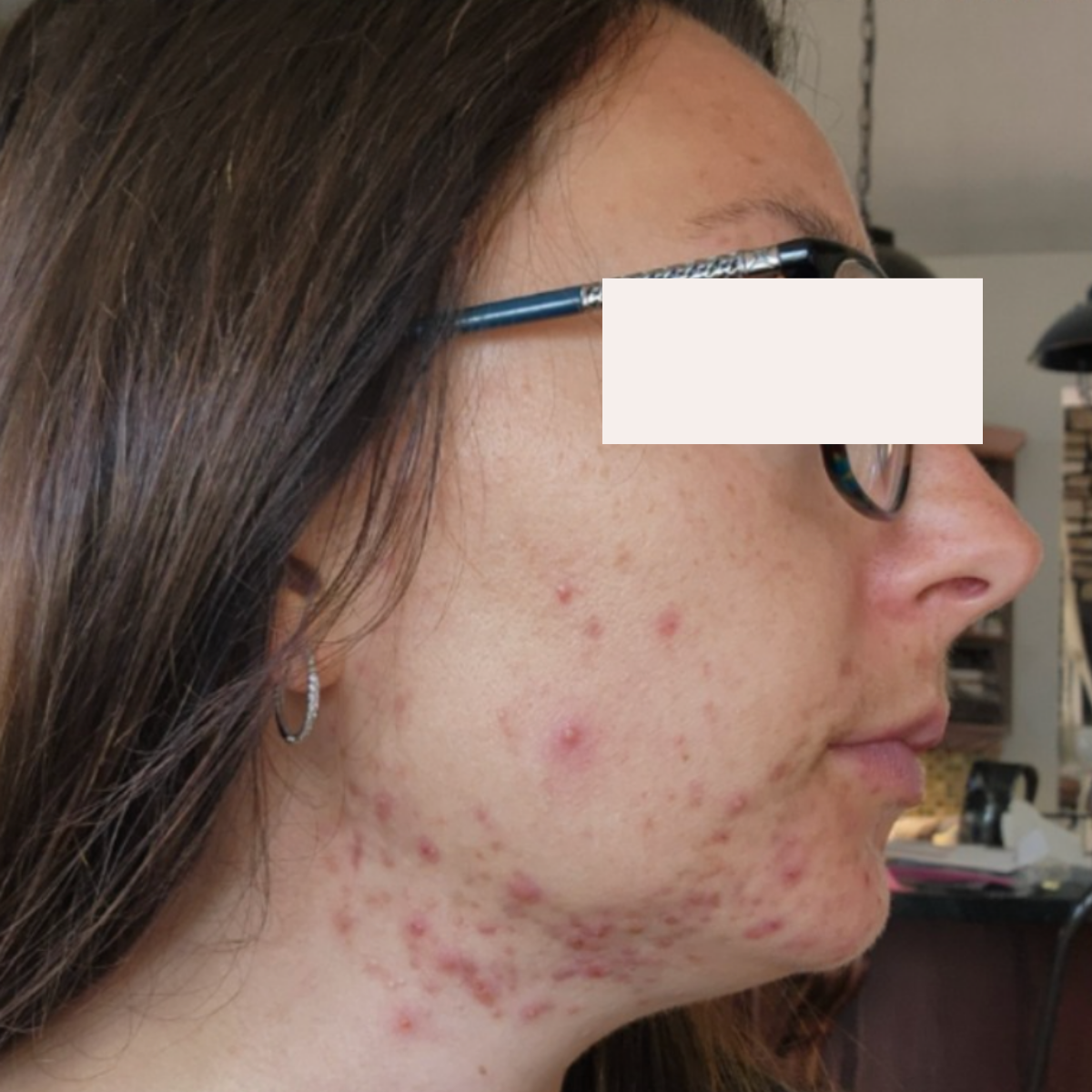 KSW Client before a historically published KSW skin journey