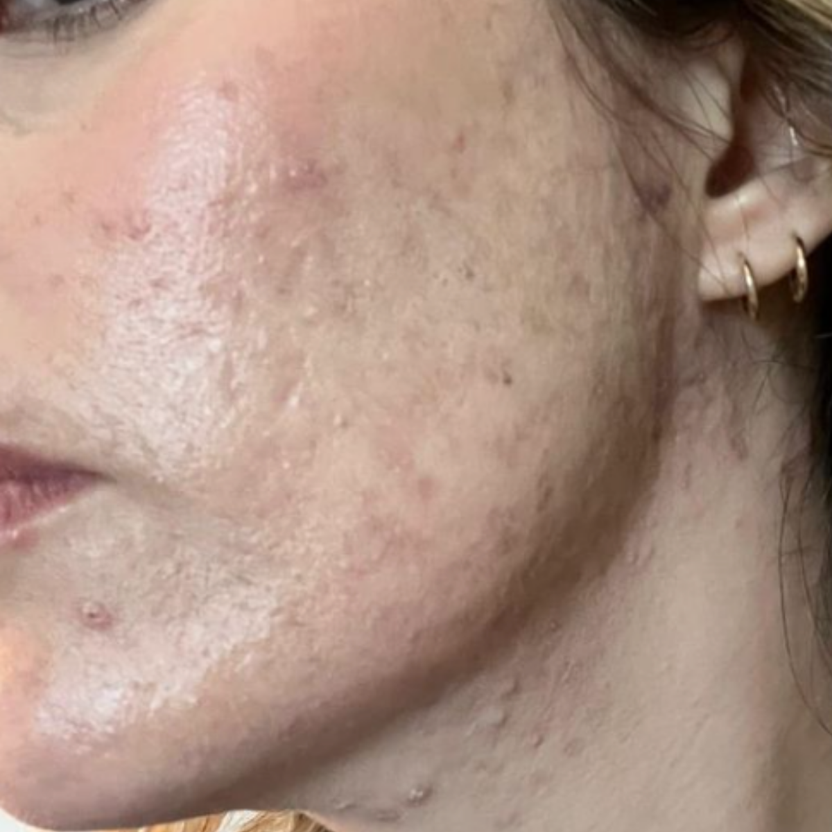 Erin C. after her documented KSW skin journey
