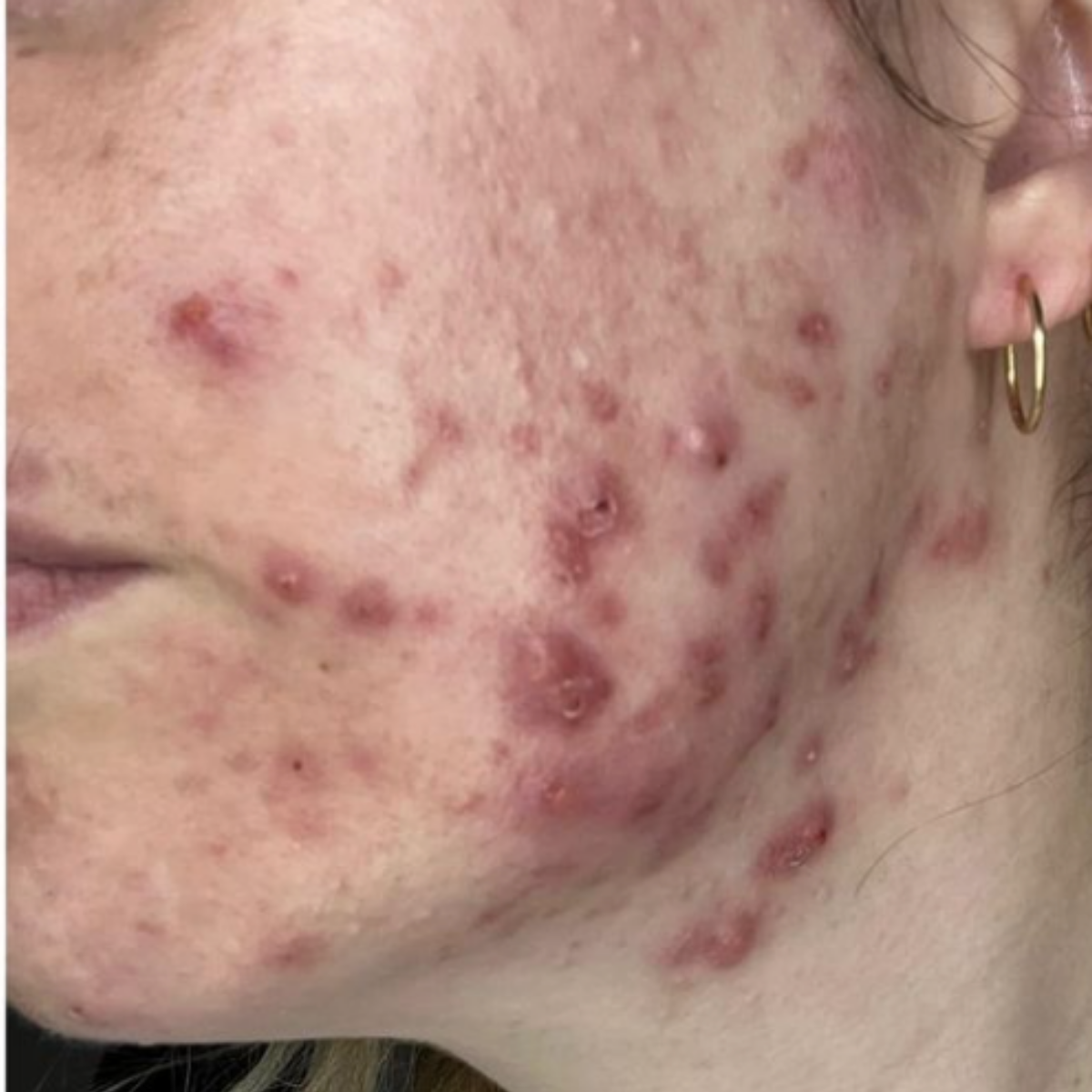 Erin C. before her documented KSW skin journey