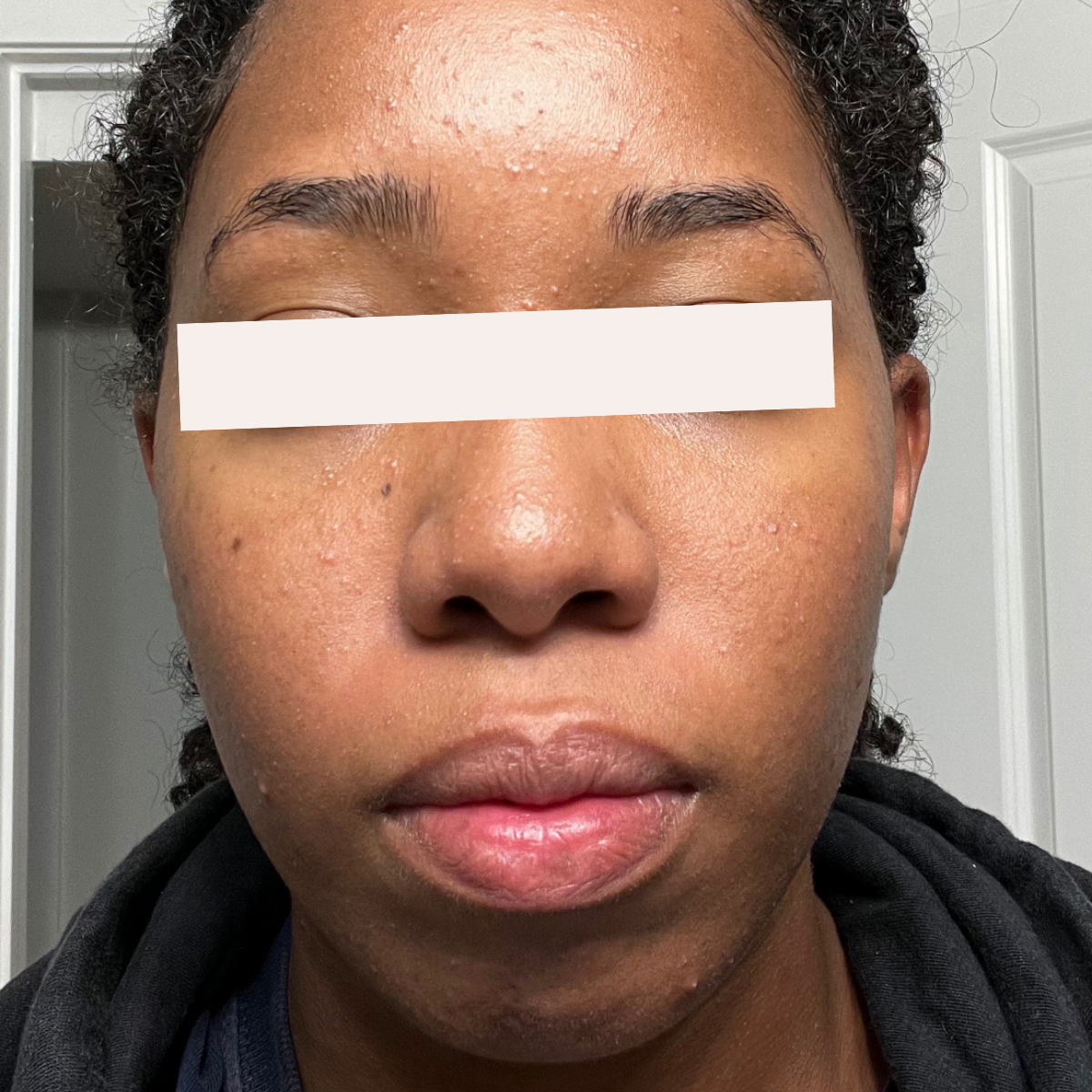 Jade before a historically published KSW skin journey