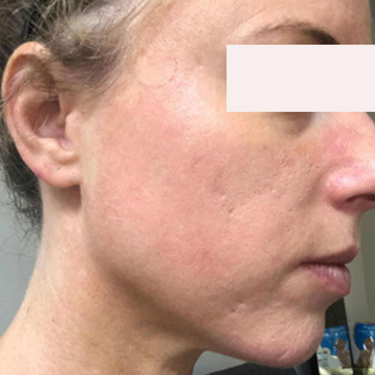 Jessica after a historically published KSW skin journey