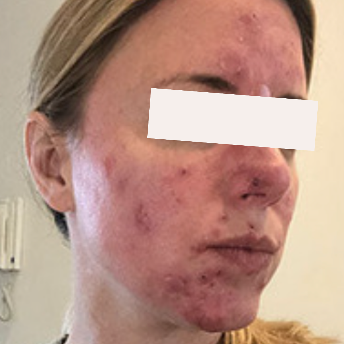 Jessica before a historically published KSW skin journey