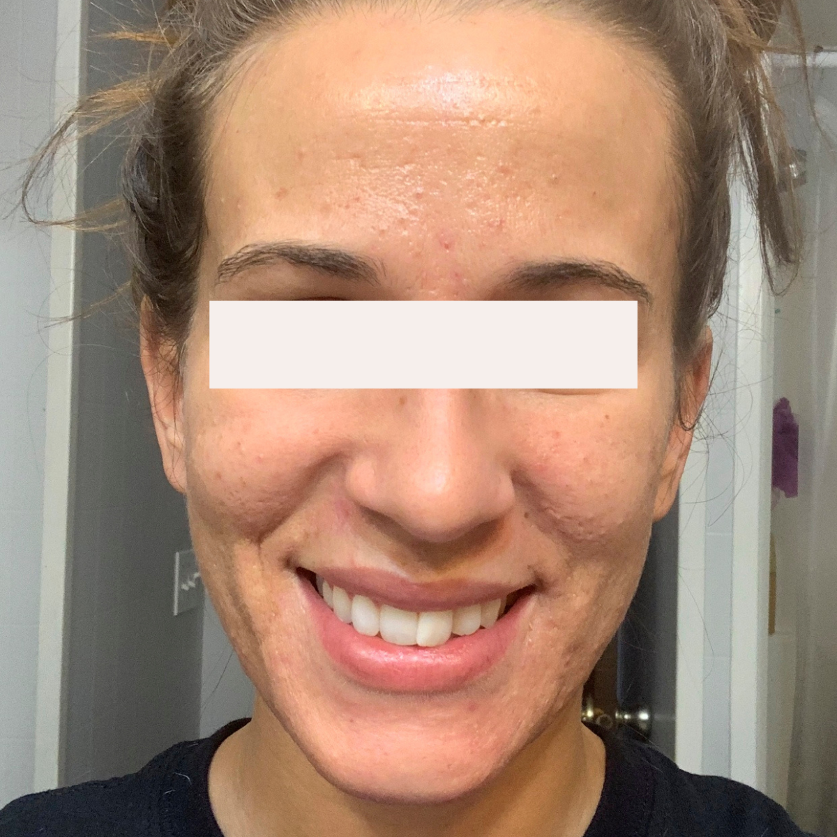 Lauren after a historically published KSW skin journey