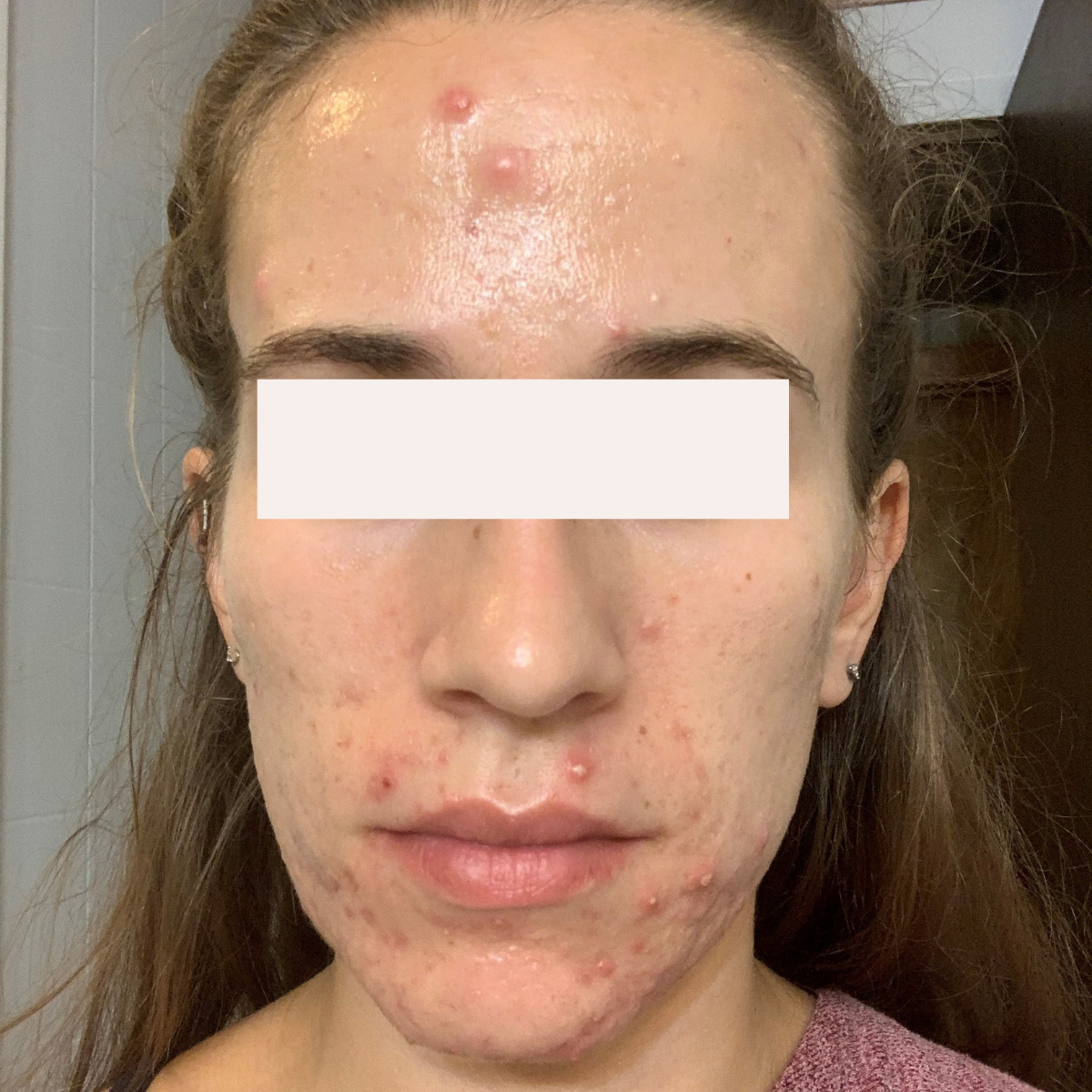 Lauren before a historically published KSW skin journey