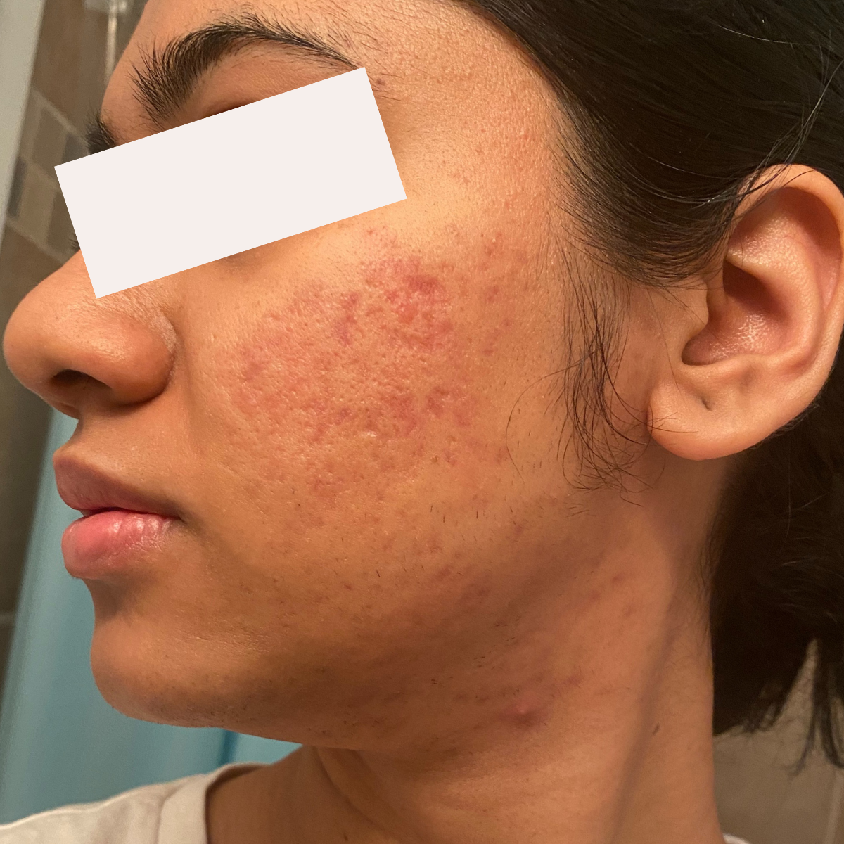 Meghana M. after her documented KSW skin journey
