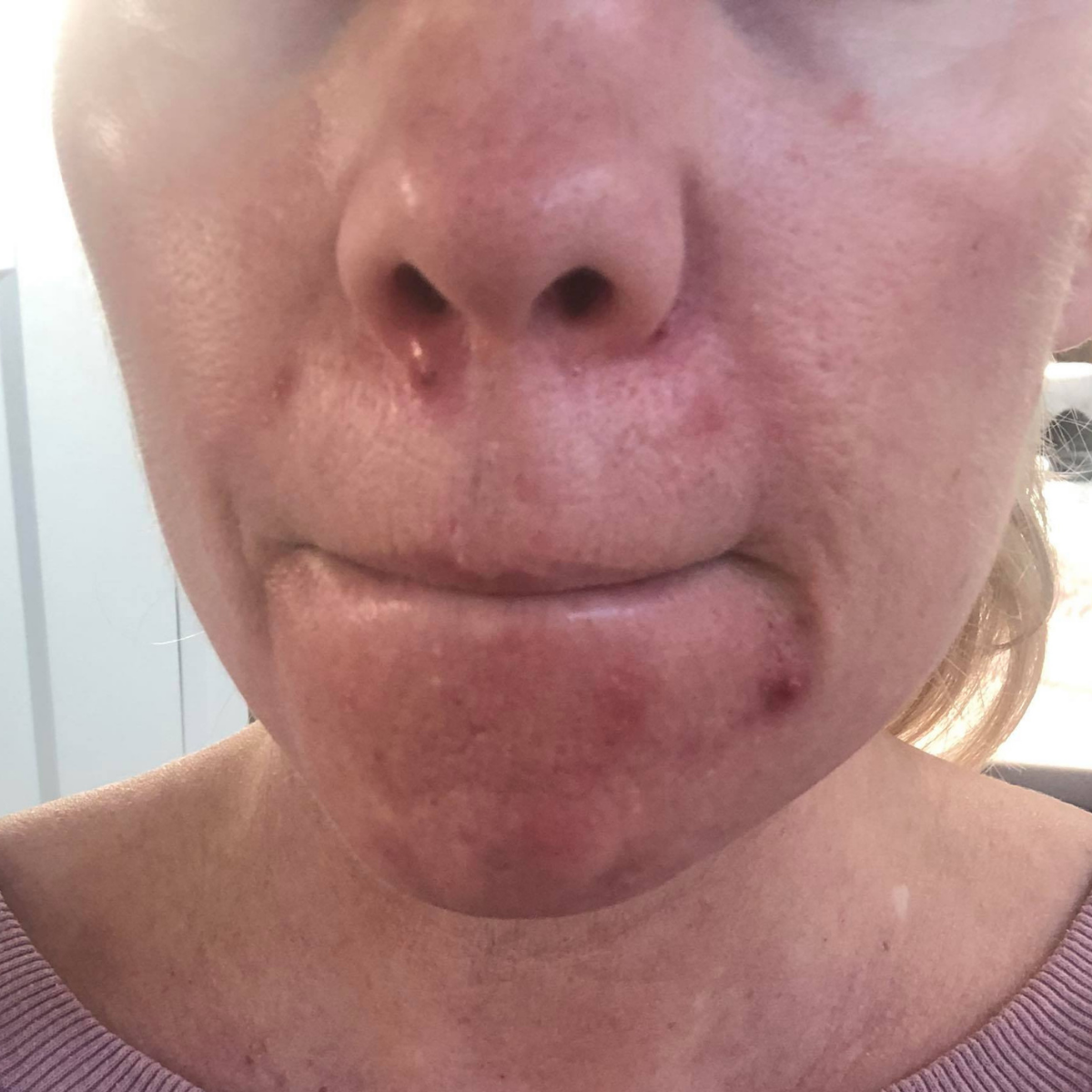 KSW Client before a historically published KSW skin journey