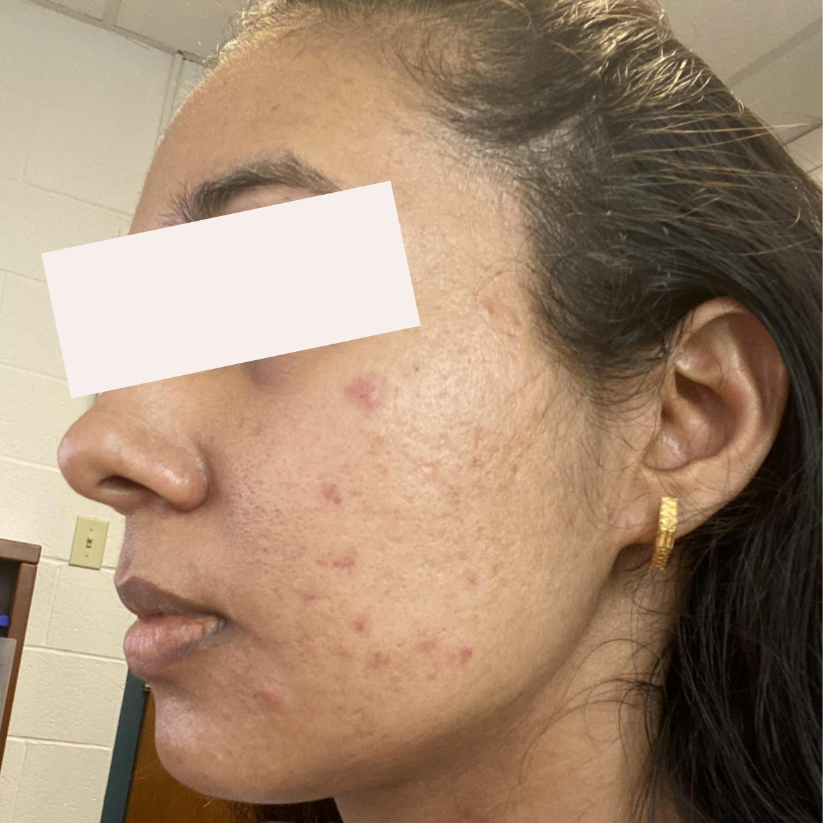 Chaitali before a historically published KSW skin journey