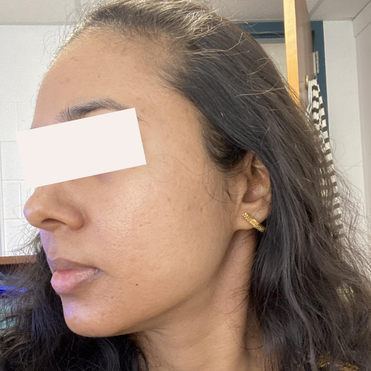 Chaitali after a historically published KSW skin journey