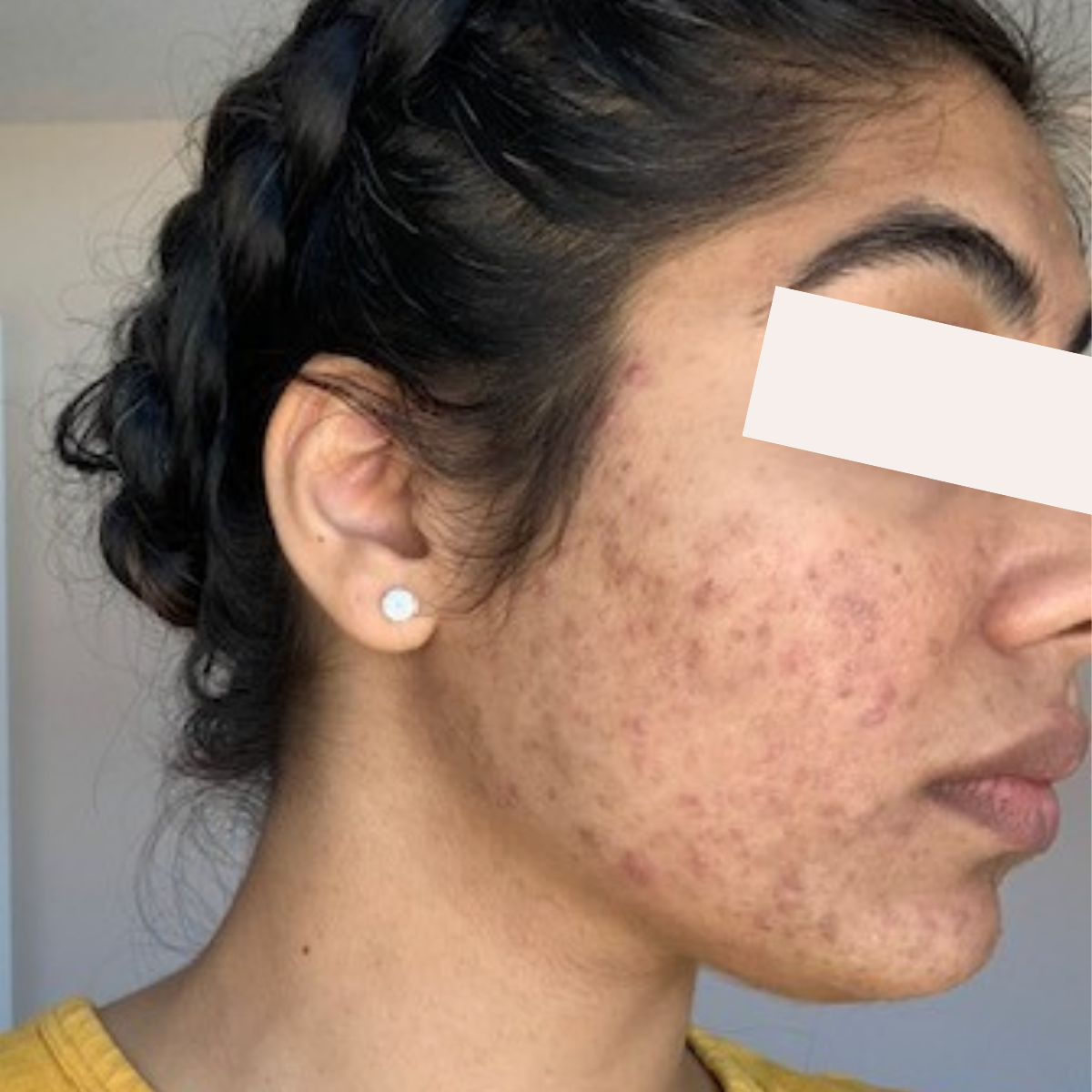 Shreeya before a historically published KSW skin journey