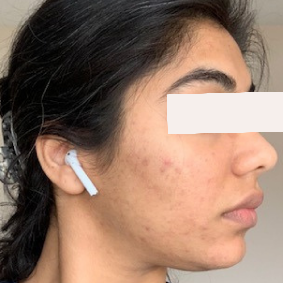 Shreeya after a historically published KSW skin journey