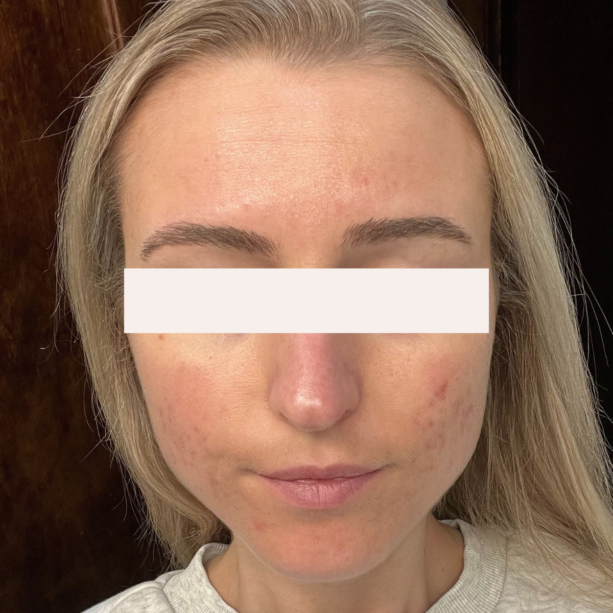 Samantha K. after her documented KSW skin journey