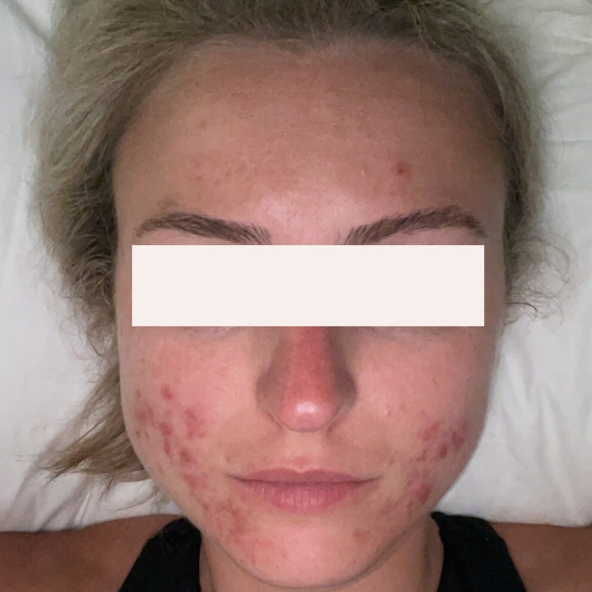 Samantha K. before her documented KSW skin journey