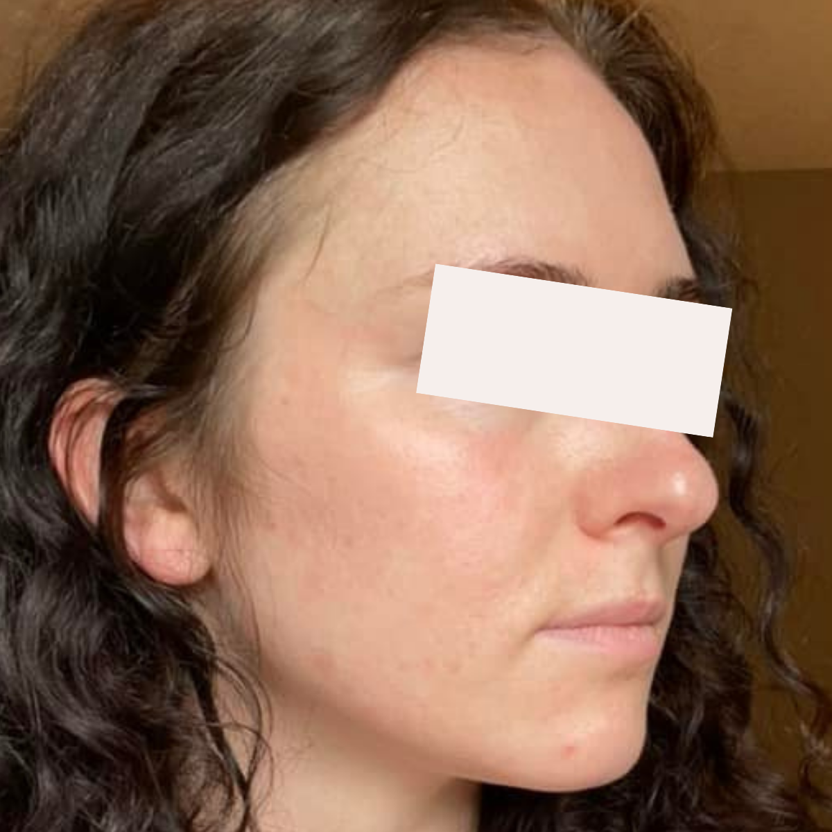 Rachel after a historically published KSW skin journey