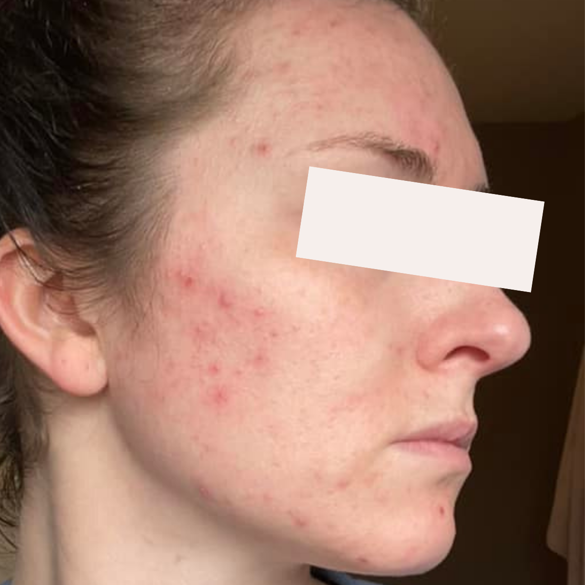 Rachel before a historically published KSW skin journey