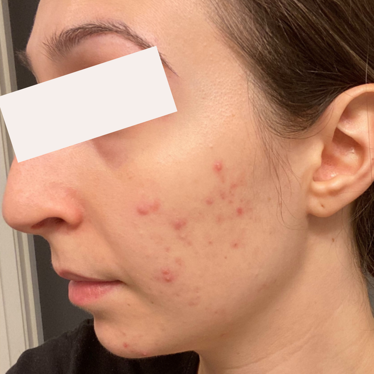 Tiana T. before her documented KSW skin journey