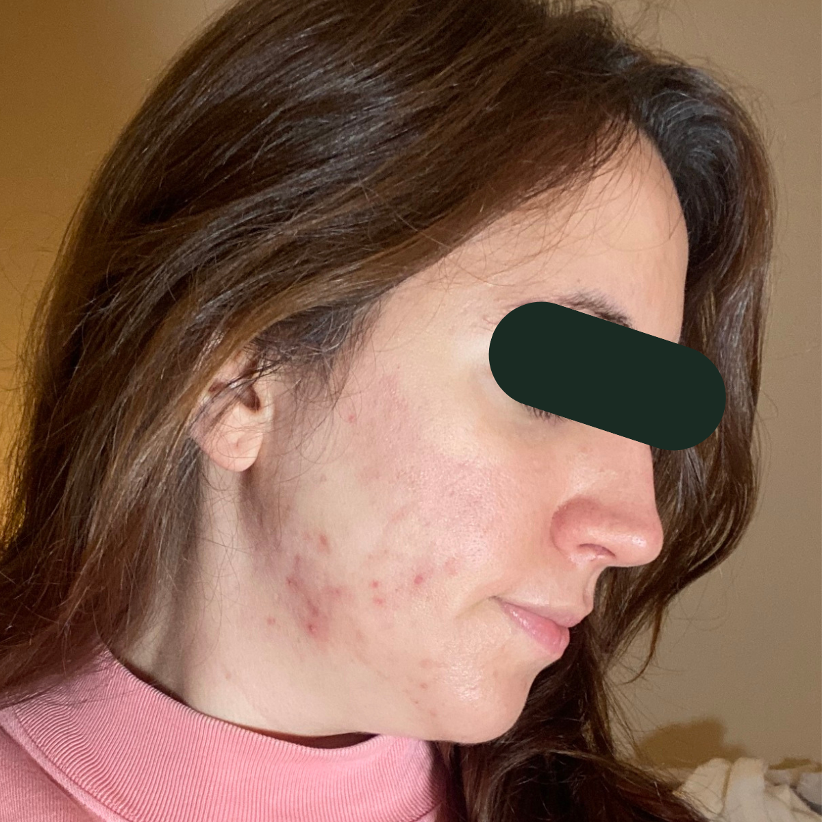 Samantha, right-profile after, eyes redacted for privacy