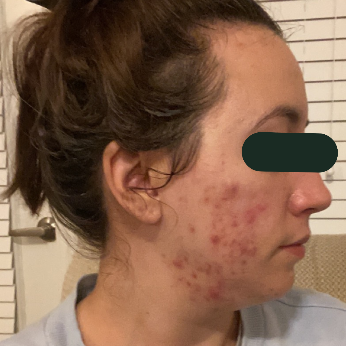 Samantha, right-profile before, eyes redacted for privacy