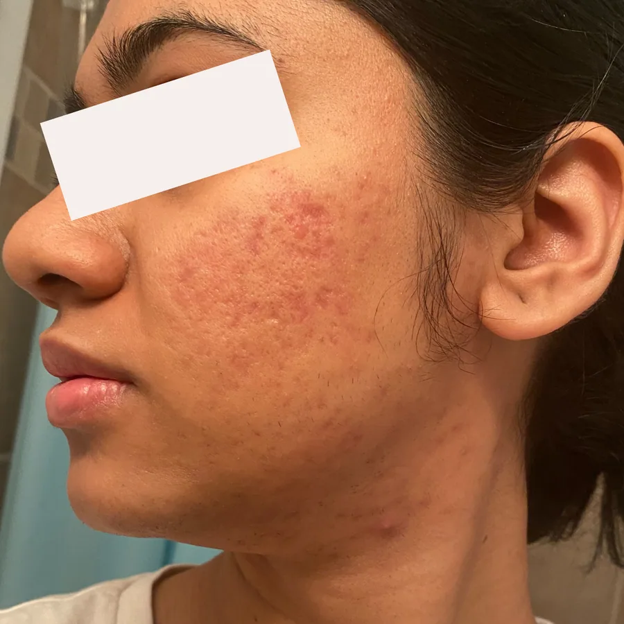 Meghana M. after her documented KSW skin journey
