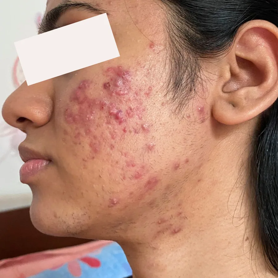 Meghana M. before her documented KSW skin journey