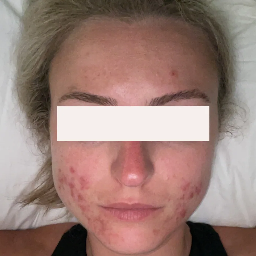 Samantha K. before her documented KSW skin journey