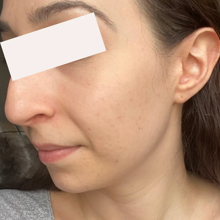 Tiana T. after her documented KSW skin journey