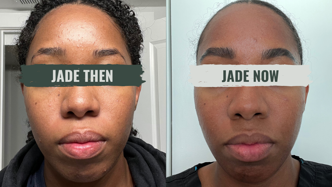 Jade's skin, then and now